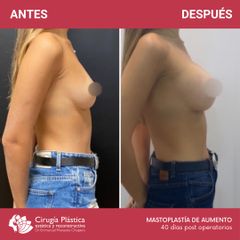 Aumento mamas - Dr. Emmanuel Manavela Chiapero