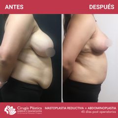 Reducción de mamas - Dr. Emmanuel Manavela Chiapero