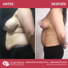 Reducción de mamas - Dr. Emmanuel Manavela Chiapero