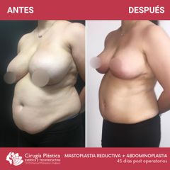 Reducción de mamas - Dr. Emmanuel Manavela Chiapero
