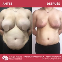 Reducción de mamas - Dr. Emmanuel Manavela Chiapero