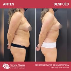 Abdominoplastia - Dr. Emmanuel Manavela Chiapero