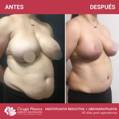 Reducción de mamas - Dr. Emmanuel Manavela Chiapero