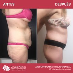 Abdominoplastia - Dr. Emmanuel Manavela Chiapero