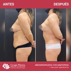 Abdominoplastia - Dr. Emmanuel Manavela Chiapero