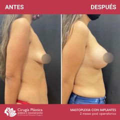 Aumento mamas - Dr. Emmanuel Manavela Chiapero