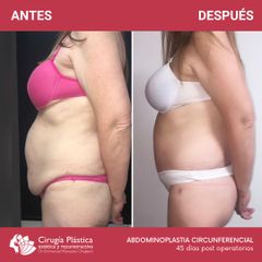 Abdominoplastia - Dr. Emmanuel Manavela Chiapero