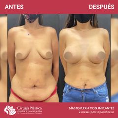 Aumento mamas - Dr. Emmanuel Manavela Chiapero