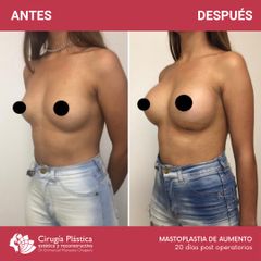 Aumento mamas - Dr. Emmanuel Manavela Chiapero