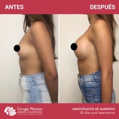 Aumento mamas - Dr. Emmanuel Manavela Chiapero