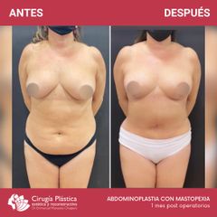 Abdominoplastia - Dr. Emmanuel Manavela Chiapero