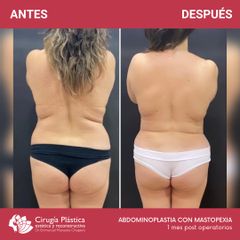 Abdominoplastia - Dr. Emmanuel Manavela Chiapero