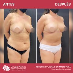 Abdominoplastia - Dr. Emmanuel Manavela Chiapero