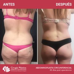 Abdominoplastia - Dr. Emmanuel Manavela Chiapero