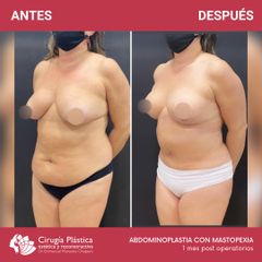 Abdominoplastia - Dr. Emmanuel Manavela Chiapero