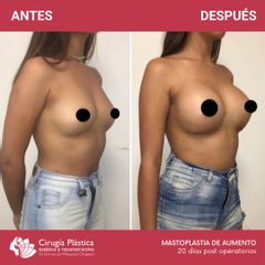 Aumento mamas - Dr. Emmanuel Manavela Chiapero