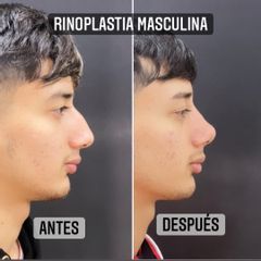 Rinoplastia - Dr. Emmanuel Manavela Chiapero