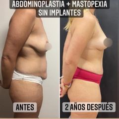 Abdominoplastia - Dr. Emmanuel Manavela Chiapero