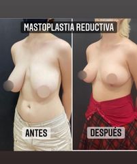 Reducción de mamas - Dr. Emmanuel Manavela Chiapero