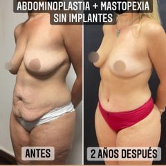 Abdominoplastia - Dr. Emmanuel Manavela Chiapero