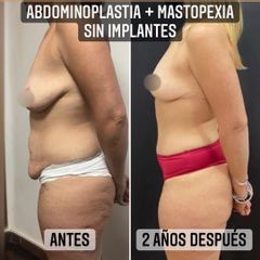 Abdominoplastia - Dr. Emmanuel Manavela Chiapero