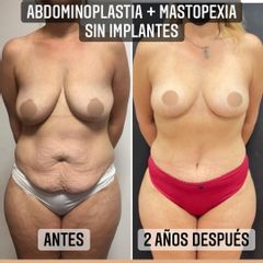 Abdominoplastia - Dr. Emmanuel Manavela Chiapero
