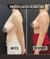Reducción de mamas - Dr. Emmanuel Manavela Chiapero