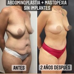 Abdominoplastia - Dr. Emmanuel Manavela Chiapero