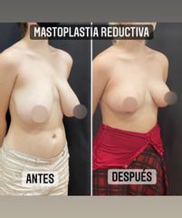 Reducción de mamas - Dr. Emmanuel Manavela Chiapero