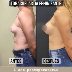Aumento mamas - Dr. Emmanuel Manavela Chiapero