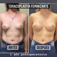 Aumento mamas - Dr. Emmanuel Manavela Chiapero