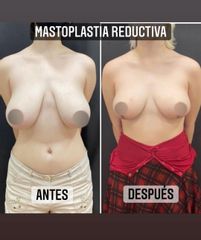 Reducción de mamas - Dr. Emmanuel Manavela Chiapero