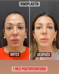Rinoplastia - Dr. Emmanuel Manavela Chiapero