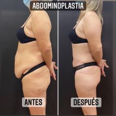 Abdominoplastia - Dr. Emmanuel Manavela Chiapero