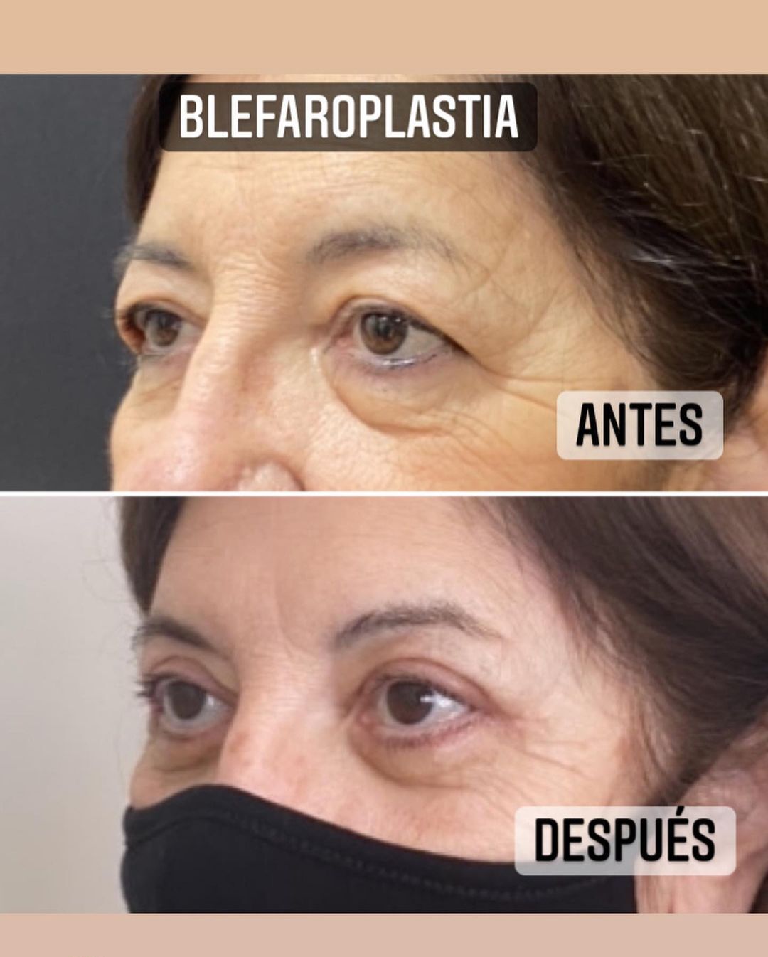 Blefaroplastia Antes Y Después Ar Ar