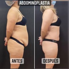 Abdominoplastia - Dr. Emmanuel Manavela Chiapero
