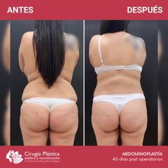 Abdominoplastia - Dr. Emmanuel Manavela Chiapero