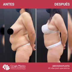 Abdominoplastia - Dr. Emmanuel Manavela Chiapero