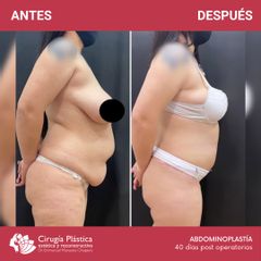 Abdominoplastia - Dr. Emmanuel Manavela Chiapero