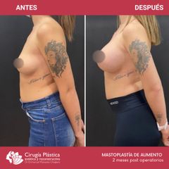 Aumento mamas - Dr. Emmanuel Manavela Chiapero
