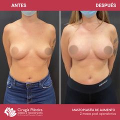 Aumento mamas - Dr. Emmanuel Manavela Chiapero