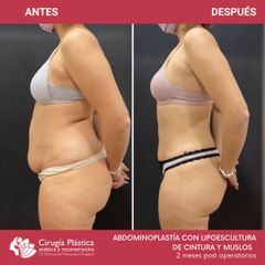 Abdominoplastia - Dr. Emmanuel Manavela Chiapero