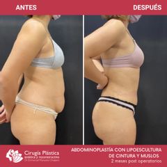 Abdominoplastia - Dr. Emmanuel Manavela Chiapero