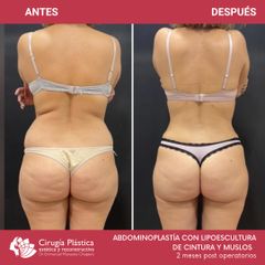 Abdominoplastia - Dr. Emmanuel Manavela Chiapero