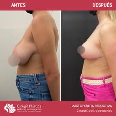 Reducción de mamas - Dr. Emmanuel Manavela Chiapero