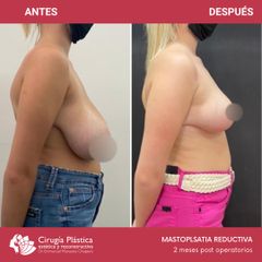 Reducción de mamas - Dr. Emmanuel Manavela Chiapero