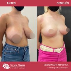 Reducción de mamas - Dr. Emmanuel Manavela Chiapero