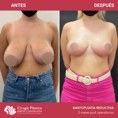 Reducción de mamas - Dr. Emmanuel Manavela Chiapero
