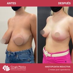 Reducción de mamas - Dr. Emmanuel Manavela Chiapero