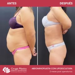 Abdominoplastia - Dr. Emmanuel Manavela Chiapero